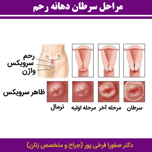 مراحل سرطان دهانه رحم