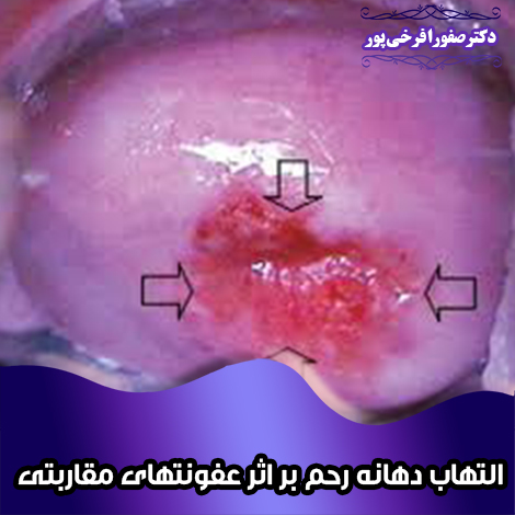 التهاب-دهانه-رحم-بر-اثر-عفونتهای-مقاربتی